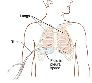 Discharge Instructions for Thoracentesis